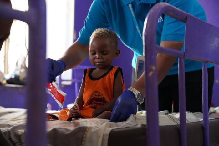 Niño con desnutrición aguda grave recibe tratamiento.