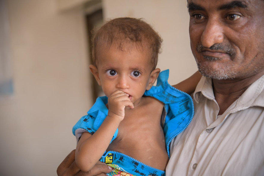 Tratamos a los niños de Yemen contra la desnutrición aguda. 