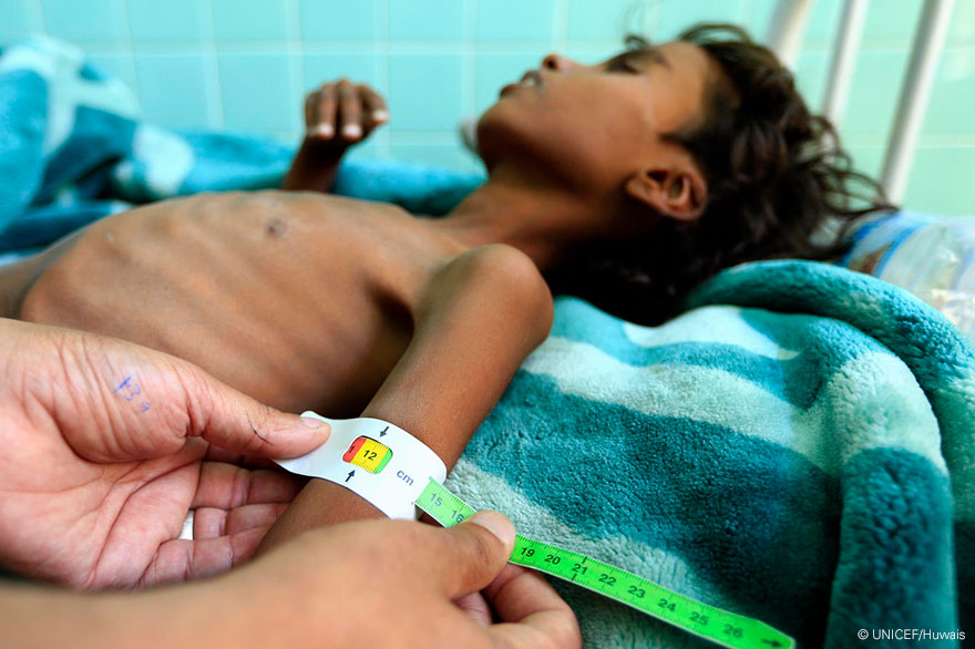 ¿Por qué los niños de Yemen están muriendo de hambre?