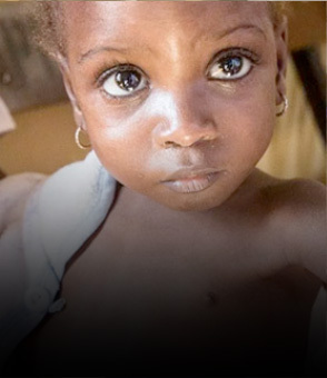 UNICEF Desnutrición