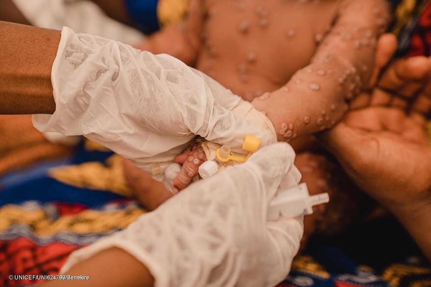 UNICEF publica una licitación de emergencia para conseguir vacunas contra la mpox