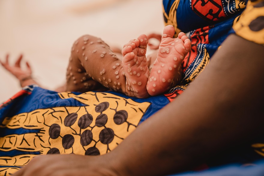 Aline, de 1 mes, en brazos de su madre en la unidad de aislamiento para mpox del Hospital Kamanyola, respaldado por UNICEF, en la provincia de Kivu del Sur, República Democrática del Congo, el 24 de julio de 2024