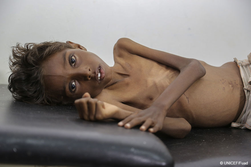 Yemen: la desnutrición consume a Mohanned