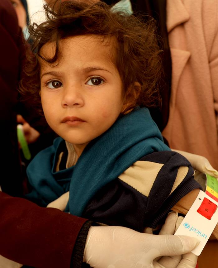 Leen, de 2 años, en un control de su estado nutricional: padece desnutrición aguda grave, como se puede ver en la franja roja de la cinta que mide la circunferencia superior de su brazo. Leen, de 2 años, en un control de su estado nutricional: padece desnutrición aguda grave, como se puede ver en la franja roja de la cinta que mide la circunferencia superior de su brazo.