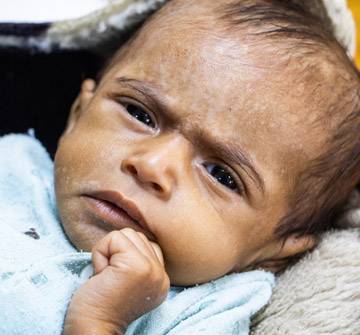 Emergencia en Yemen Un bebé en Yemen