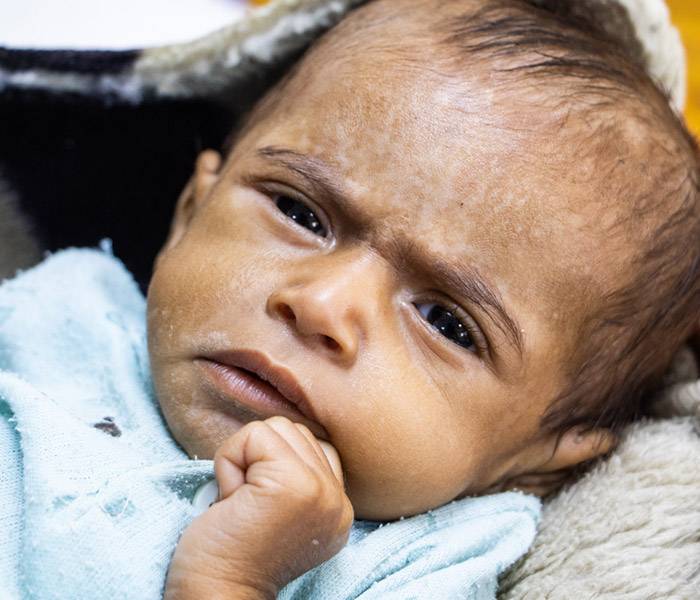 Emergencia en Yemen Un bebé en Yemen